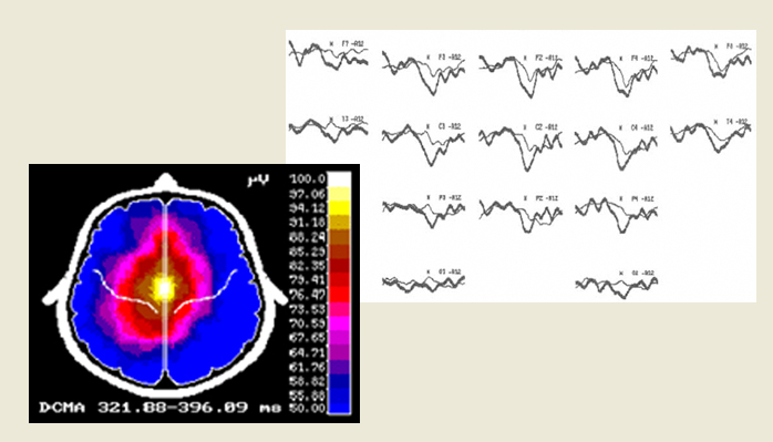 Mapa cerebral y registro del potencial evocado cognitivo N400 en INCIA