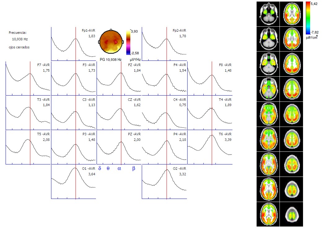 Cartografía cerebral y trazados de EEG cuantificado (QEEG) realizados en INCIA