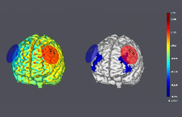 Modelos 3D del cerebro con zonas de activación en el tratamiento de los trastornos del estado de ánimo en INCIA