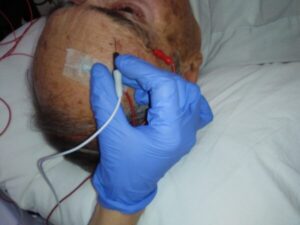 Colocación de electrodos para un estudio neurofisiológico facial en INCIA
